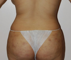 Liposuction