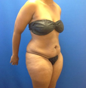 Liposuction